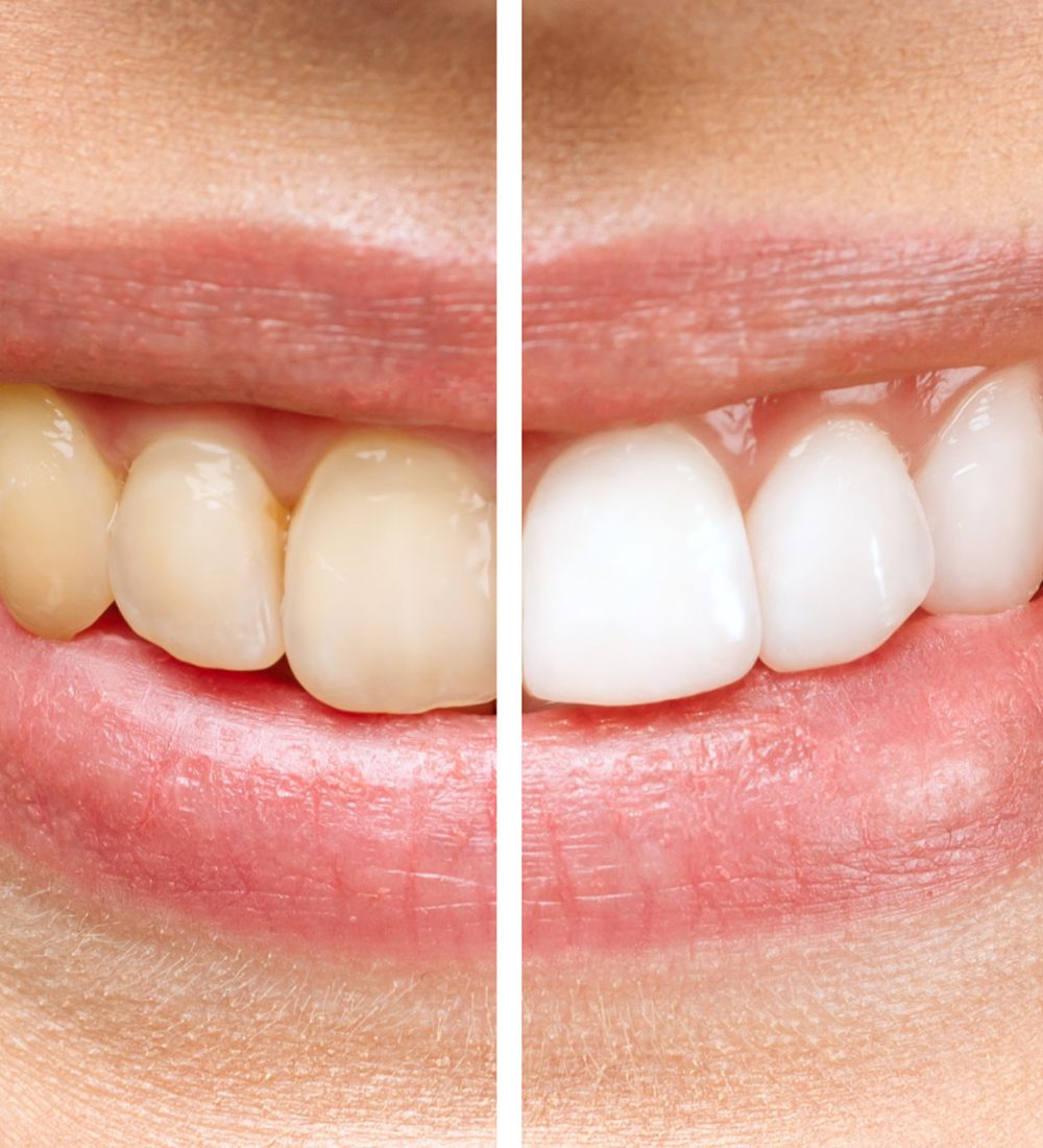 clareamento-de-dente-em-são-joão-del-rei