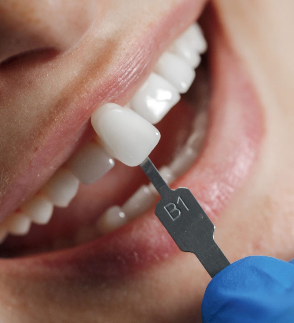 facetas-de-porcelana-em-são-joão-del-rei-mg